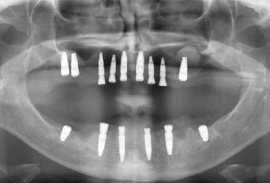 botiss maxresorb® inject for sinus lift - clinical case