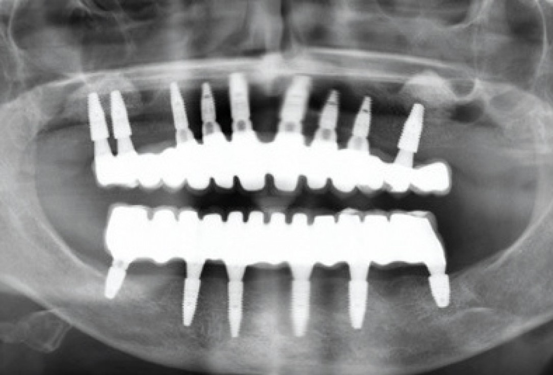 botiss maxresorb® inject for sinus lift - clinical case