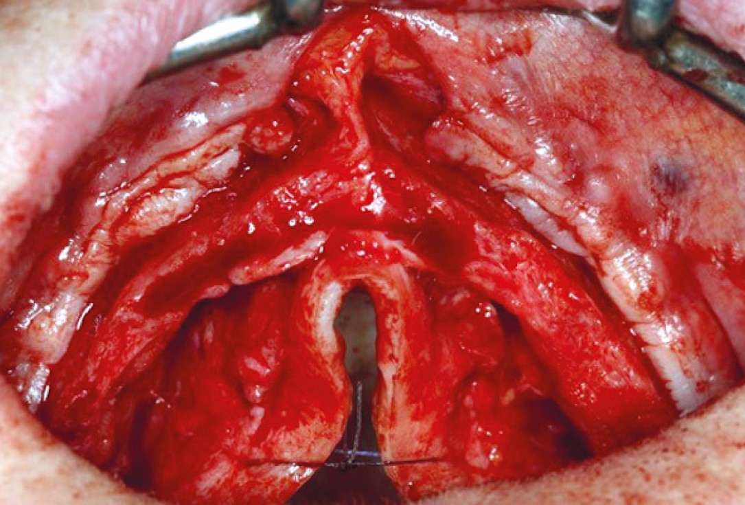 botiss maxresorb® inject for sinus lift - clinical case