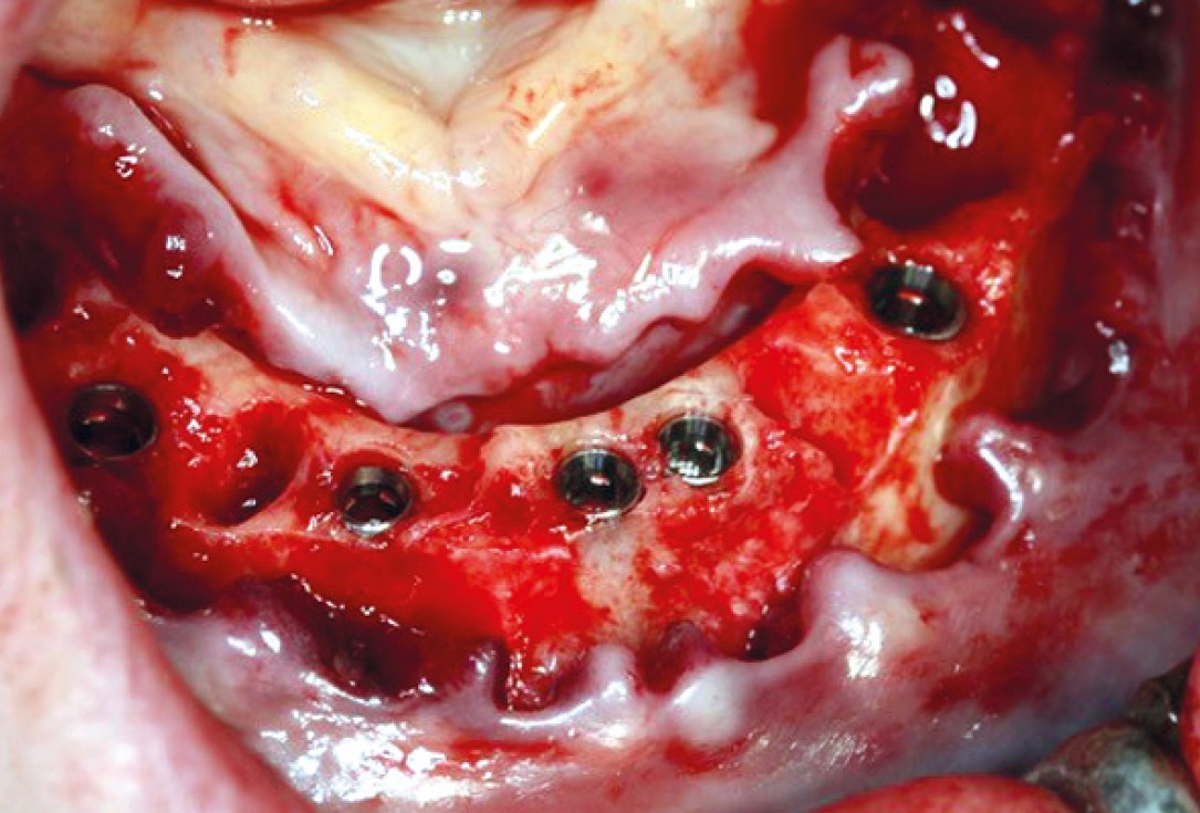 botiss maxresorb® inject for sinus lift - clinical case