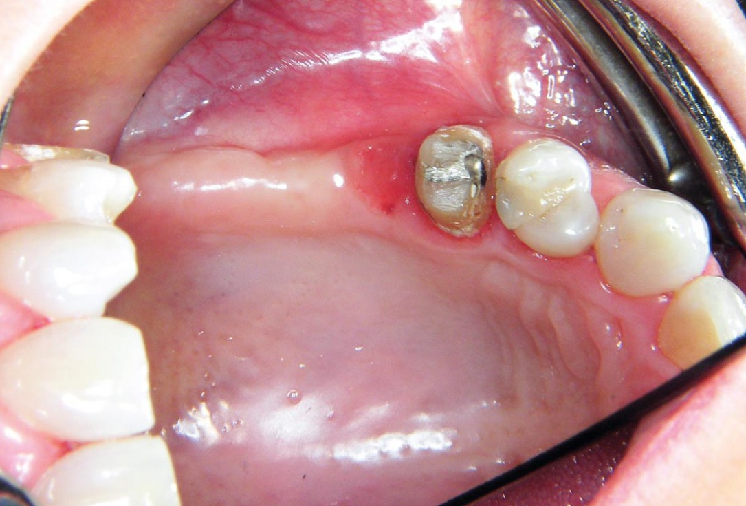 Two-stage sinus floor elevation and horizontal GBR using cerabone®, autologous bone and Jason® membrane - Dr. M. Blašković