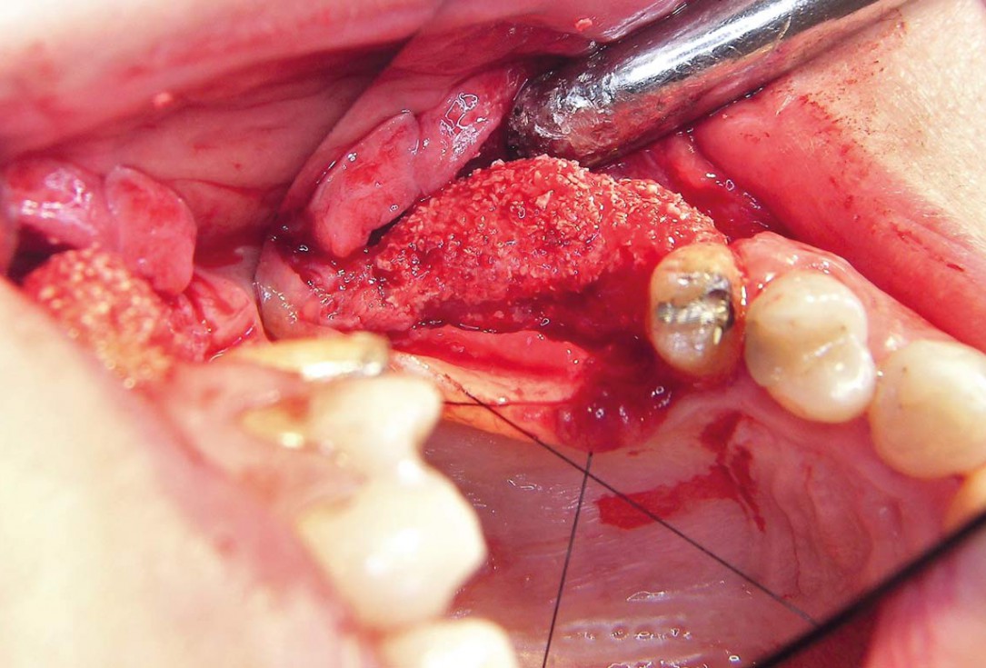Two-stage sinus floor elevation and horizontal GBR using cerabone®, autologous bone and Jason® membrane - Dr. M. Blašković