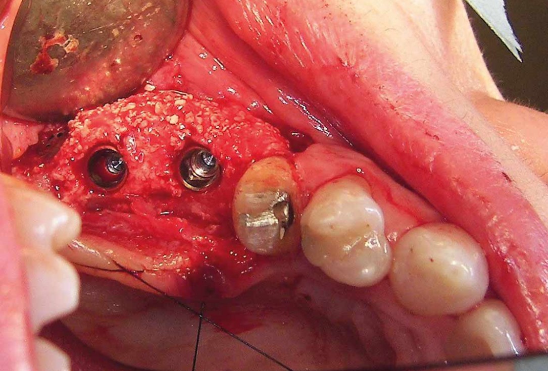 Two-stage sinus floor elevation and horizontal GBR using cerabone®, autologous bone and Jason® membrane - Dr. M. Blašković