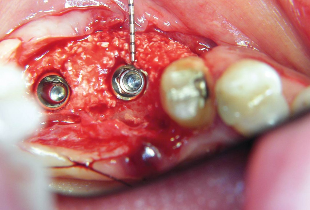 Two-stage sinus floor elevation and horizontal GBR using cerabone®, autologous bone and Jason® membrane - Dr. M. Blašković