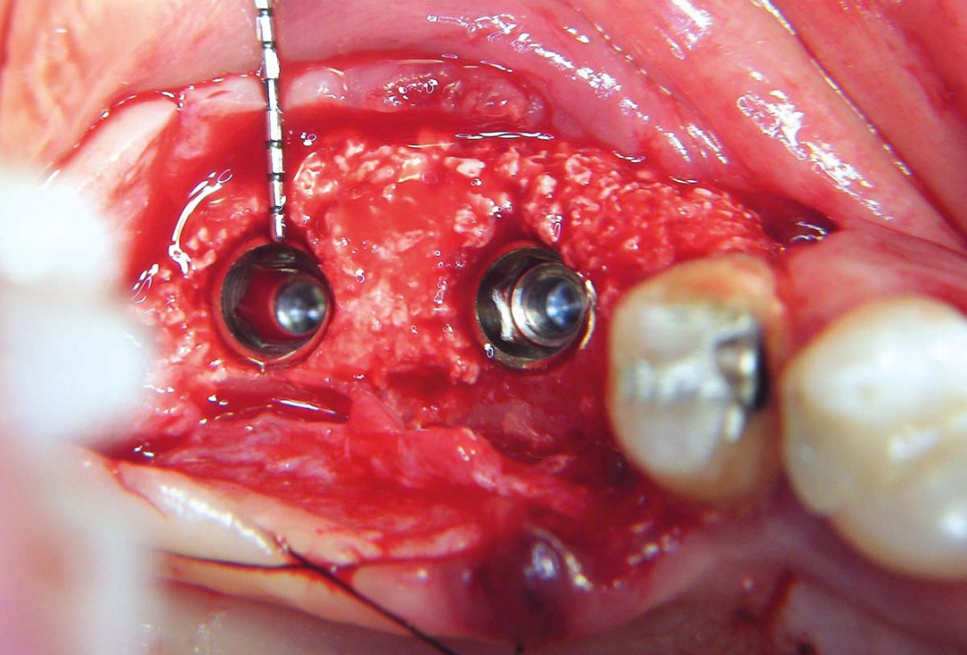 Two-stage sinus floor elevation and horizontal GBR using cerabone®, autologous bone and Jason® membrane - Dr. M. Blašković