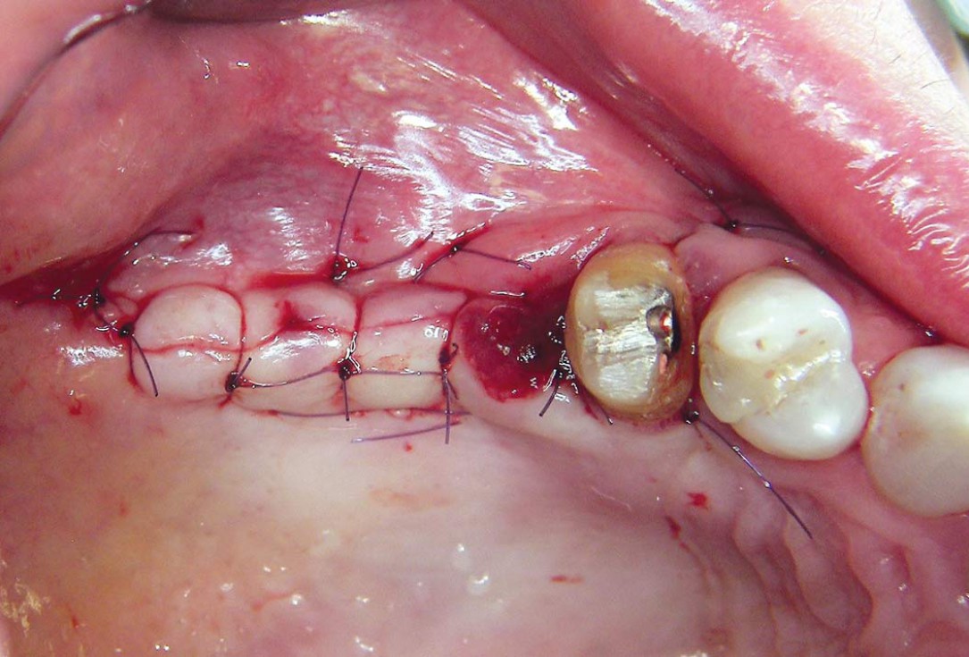 Two-stage sinus floor elevation and horizontal GBR using cerabone®, autologous bone and Jason® membrane - Dr. M. Blašković