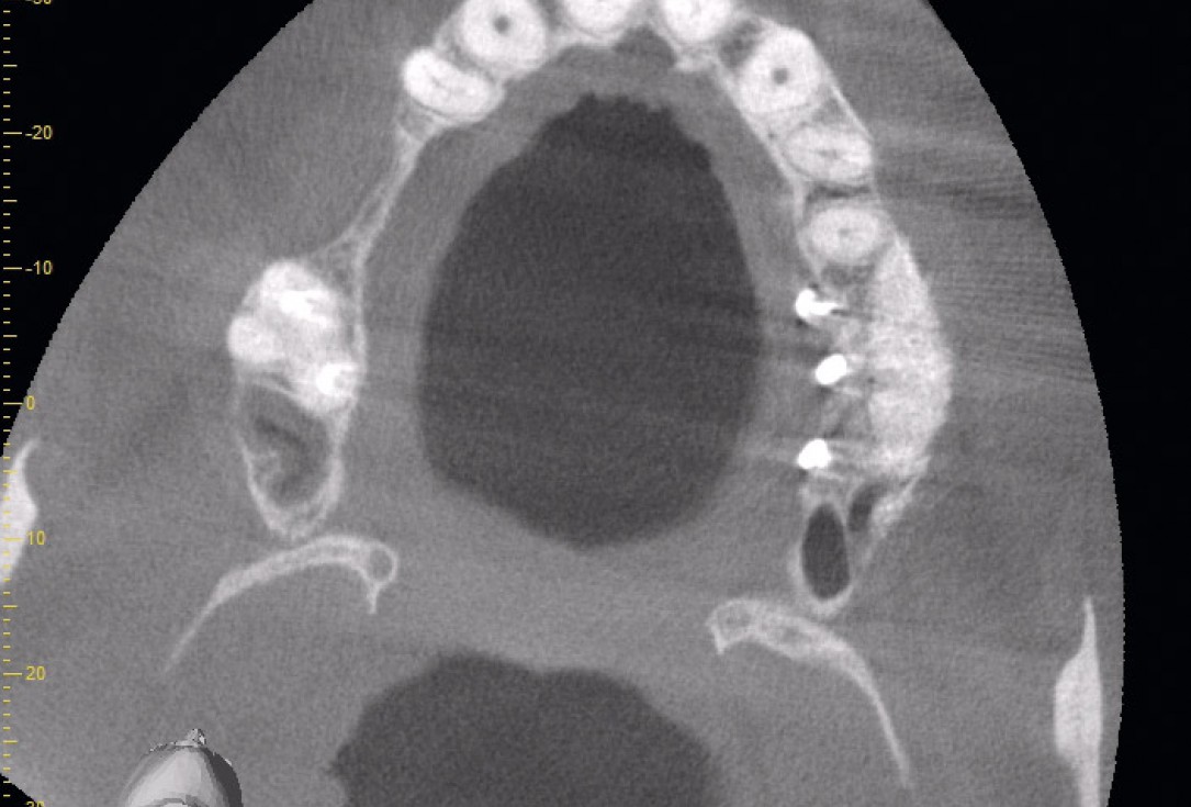 Two-stage sinus floor elevation and horizontal GBR using cerabone®, autologous bone and Jason® membrane - Dr. M. Blašković