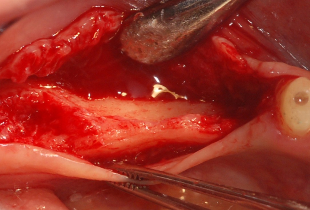 botiss cerabone® & collprotect® membrane for GBR - Clinical case by Dr. V. Kalenchuk