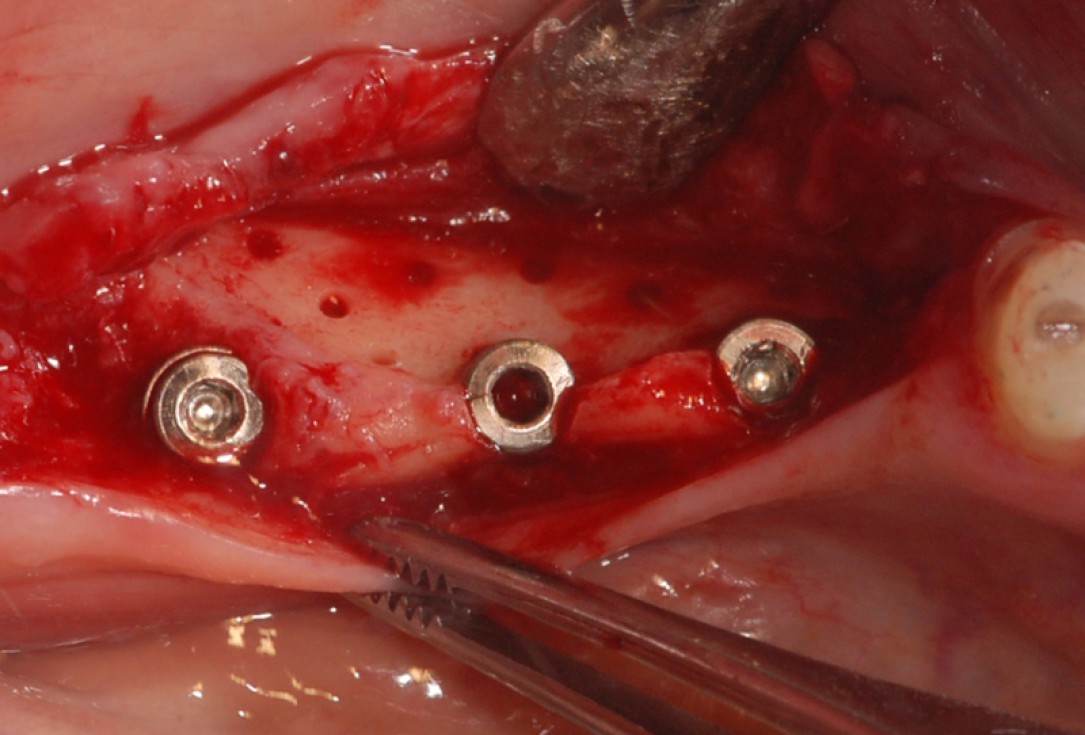 botiss cerabone® & collprotect® membrane for GBR - Clinical case by Dr. V. Kalenchuk