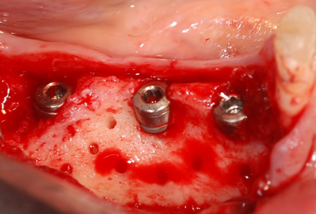 botiss cerabone® & collprotect® membrane for GBR - Clinical case by Dr. V. Kalenchuk