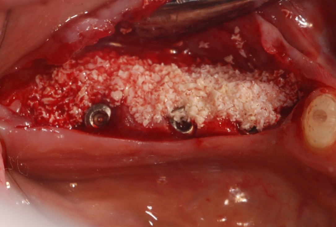 botiss cerabone® & collprotect® membrane for GBR - Clinical case by Dr. V. Kalenchuk