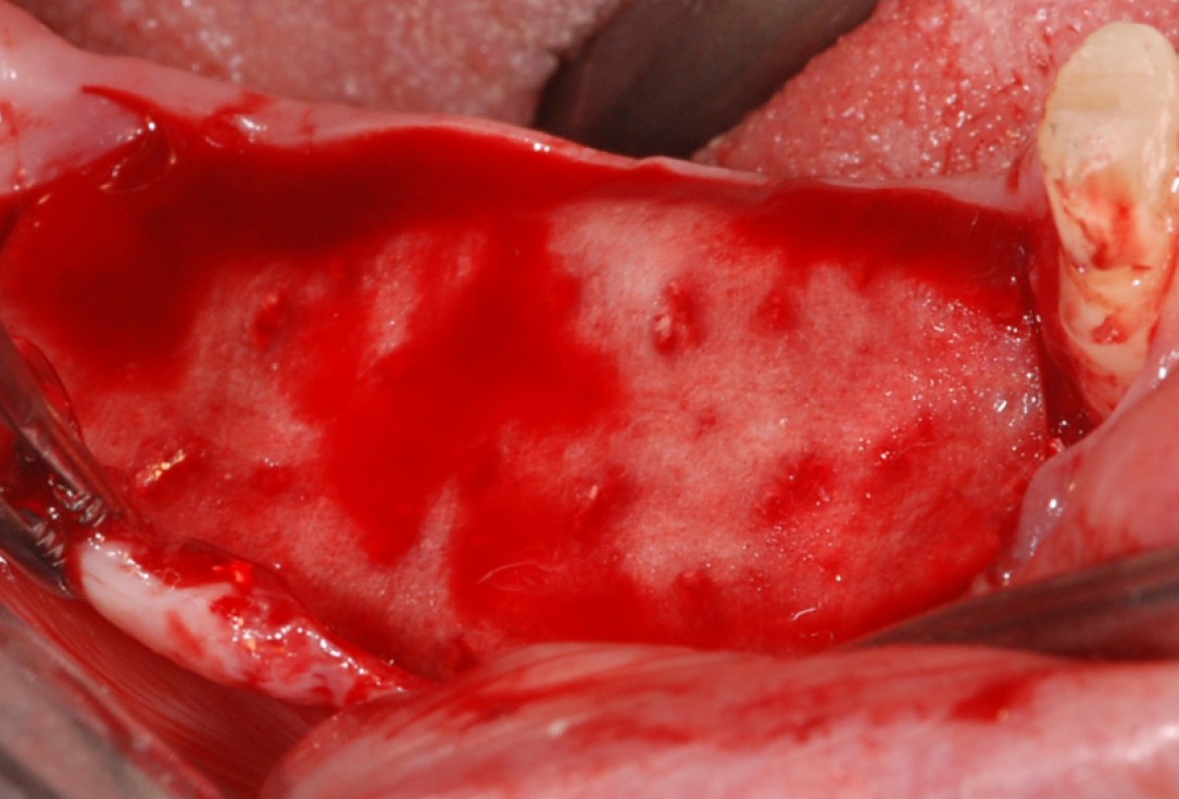 botiss cerabone® & collprotect® membrane for GBR - Clinical case by Dr. V. Kalenchuk