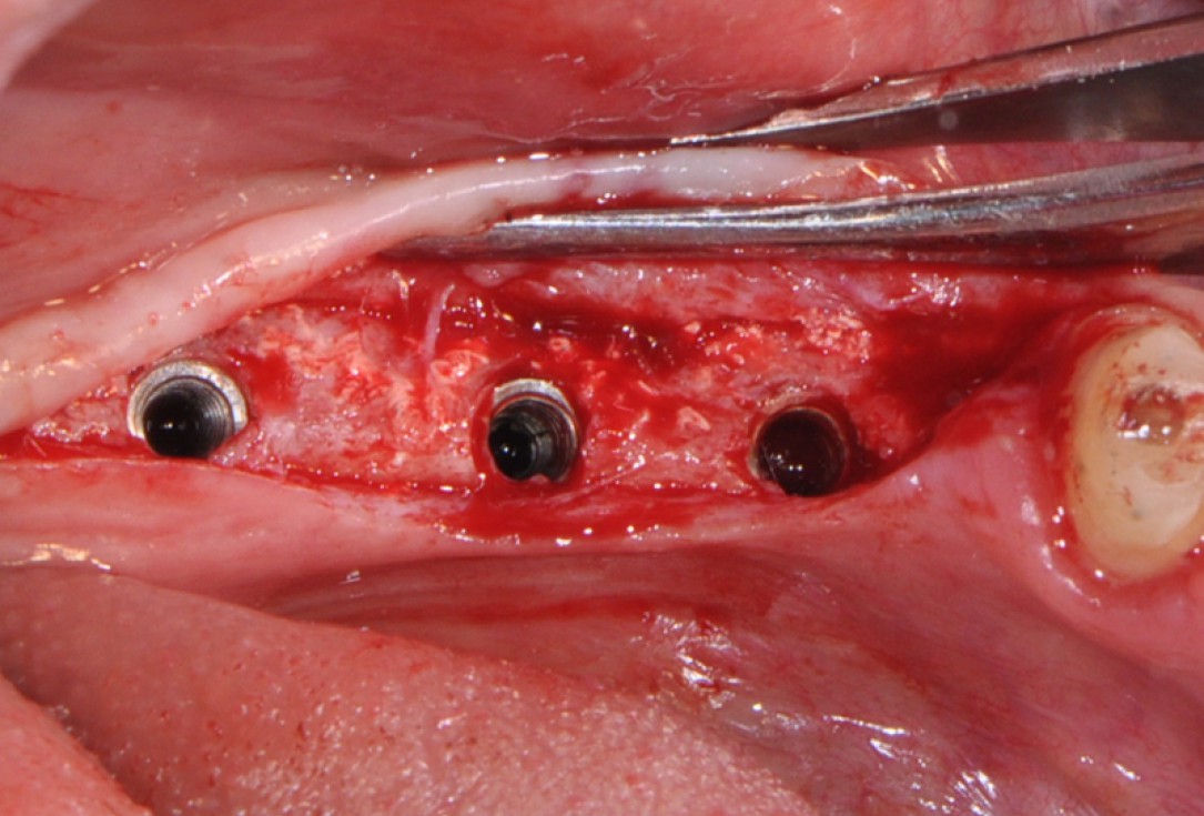 botiss cerabone® & collprotect® membrane for GBR - Clinical case by Dr. V. Kalenchuk