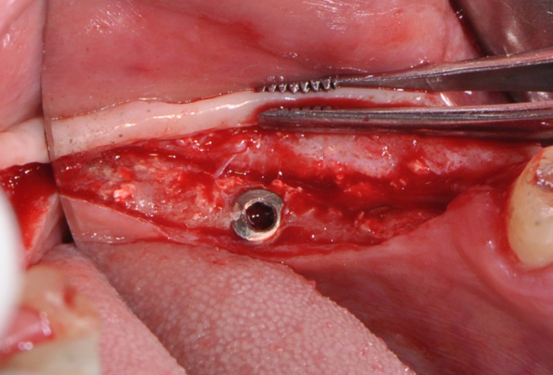 botiss cerabone® & collprotect® membrane for GBR - Clinical case by Dr. V. Kalenchuk