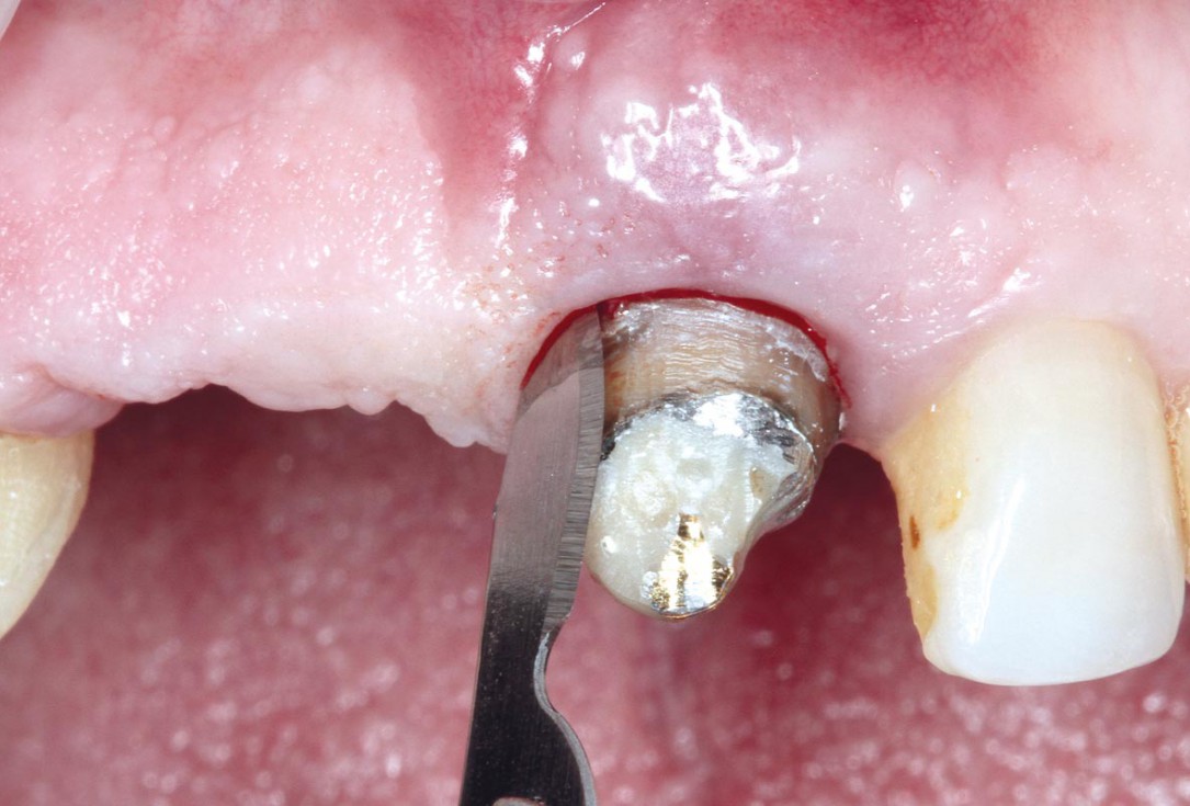 Socket preservation using cerabone® and Straumann® Emdogain® - Dr. S. Pelekanos