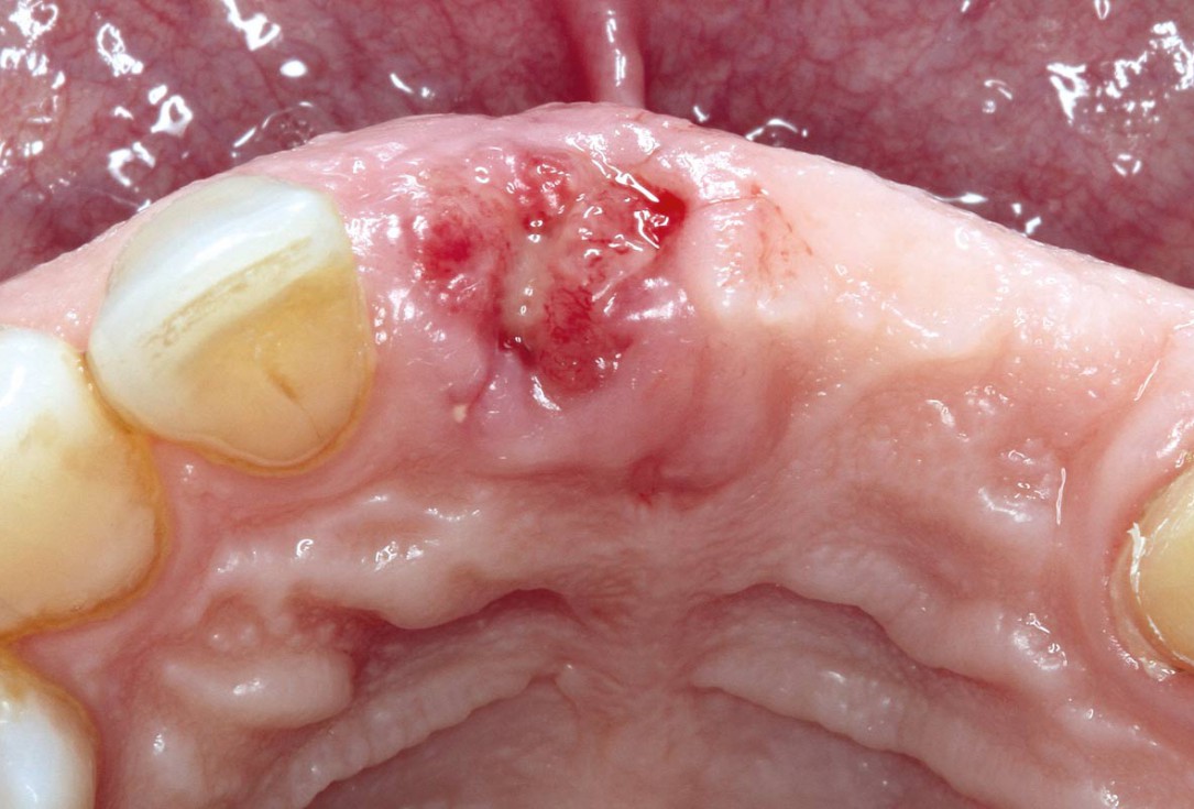 Socket preservation using cerabone® and Straumann® Emdogain® - Dr. S. Pelekanos