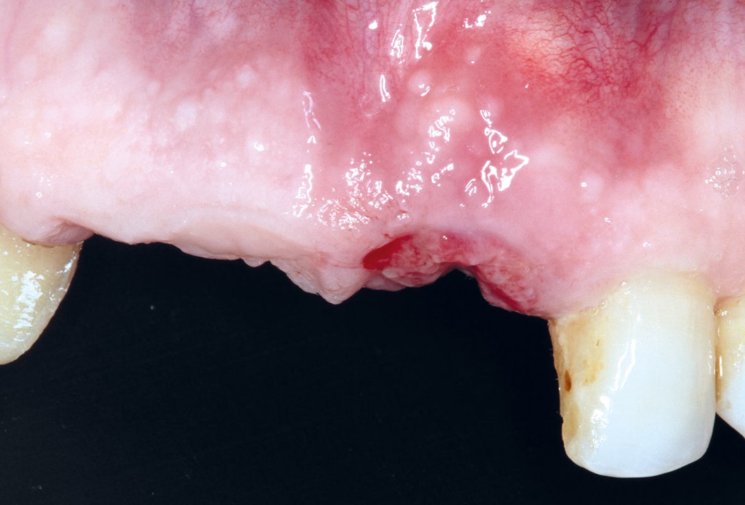 Socket preservation using cerabone® and Straumann® Emdogain® - Dr. S. Pelekanos