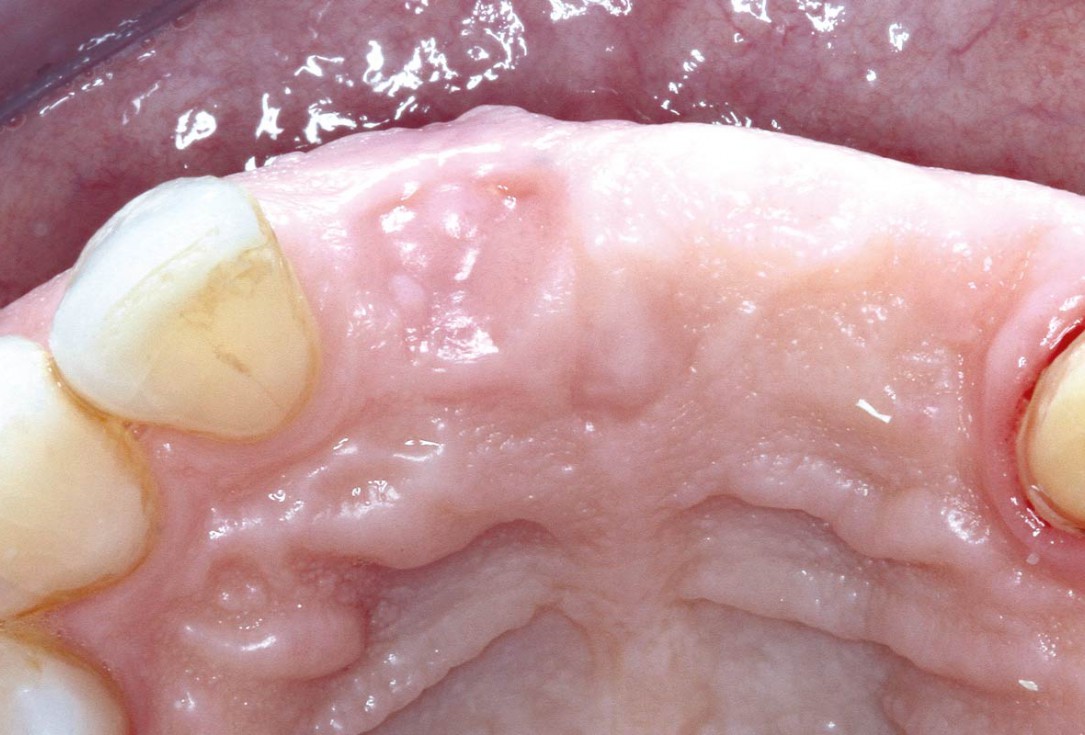 Socket preservation using cerabone® and Straumann® Emdogain® - Dr. S. Pelekanos