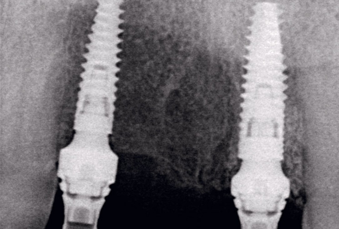 Socket preservation using cerabone® and Straumann® Emdogain® - Dr. S. Pelekanos