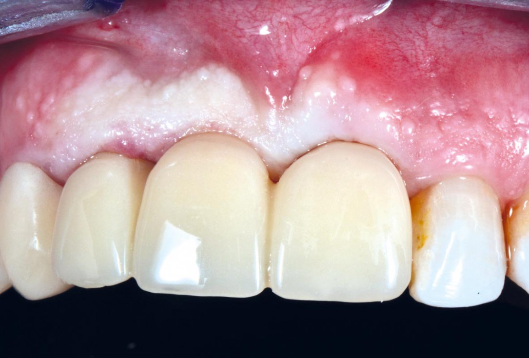 Socket preservation using cerabone® and Straumann® Emdogain® - Dr. S. Pelekanos