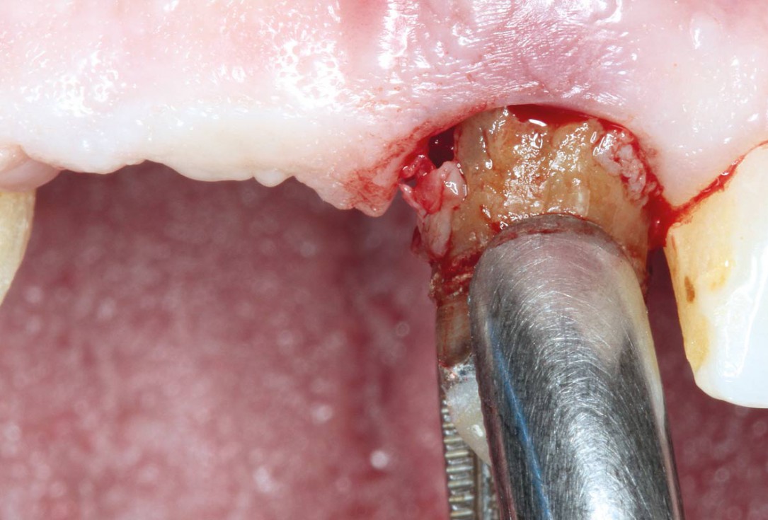 Socket preservation using cerabone® and Straumann® Emdogain® - Dr. S. Pelekanos