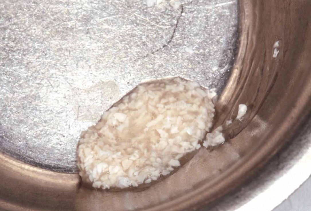 Socket preservation using cerabone® and Straumann® Emdogain® - Dr. S. Pelekanos