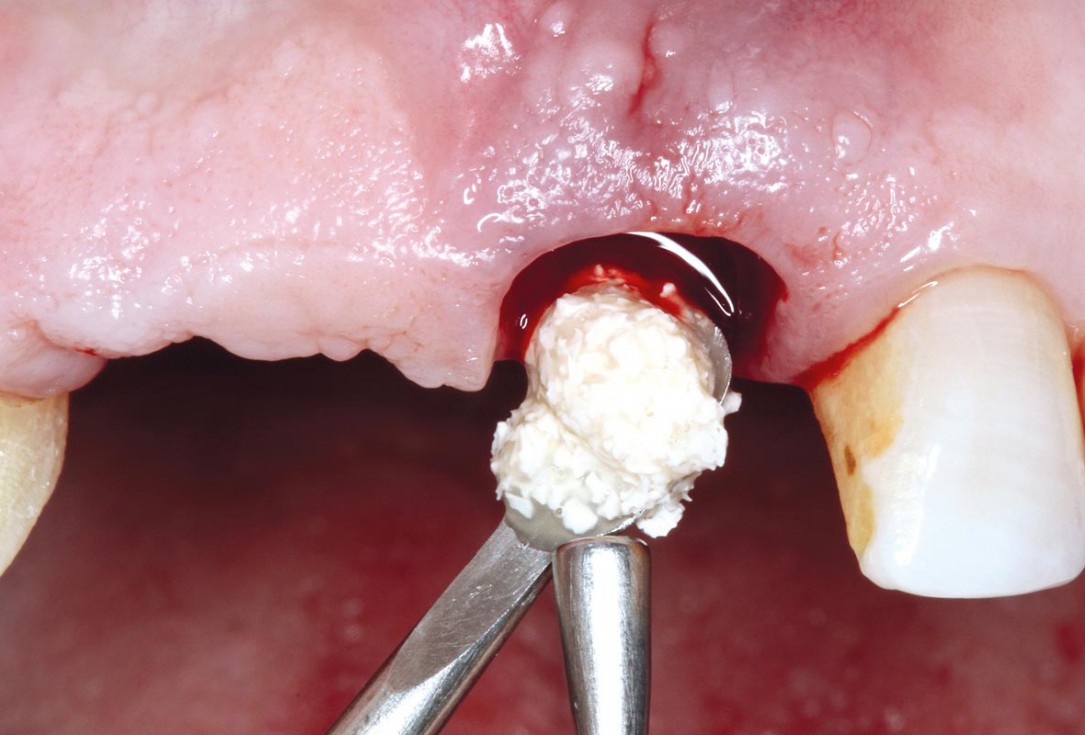Socket preservation using cerabone® and Straumann® Emdogain® - Dr. S. Pelekanos