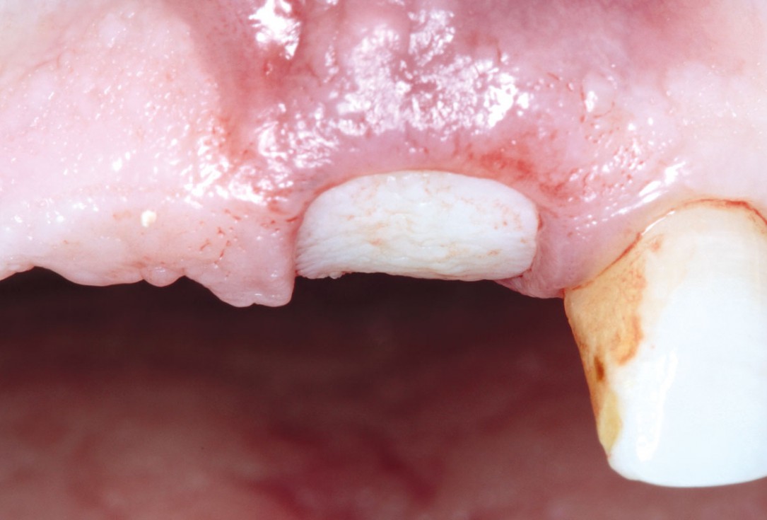 Socket preservation using cerabone® and Straumann® Emdogain® - Dr. S. Pelekanos