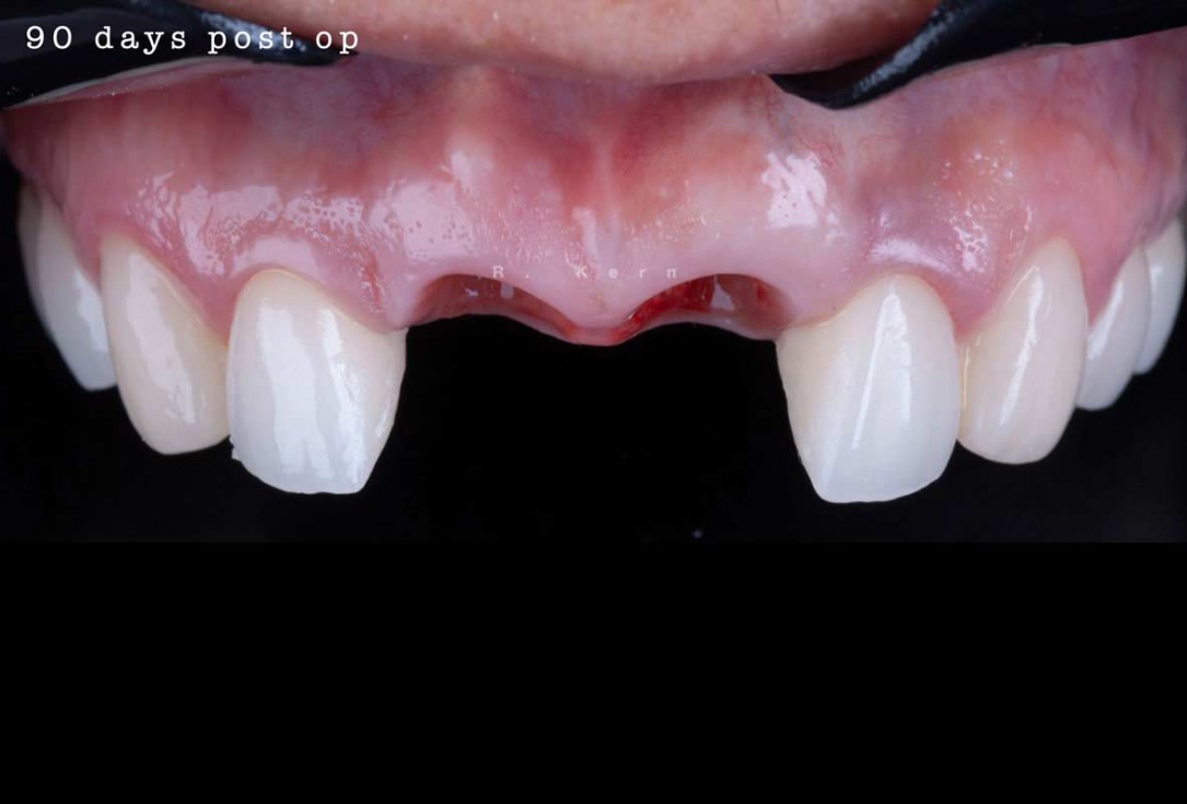 Immediate implant placement and periimplant bone augmentation using cerabone® - Dr. R. Kern 