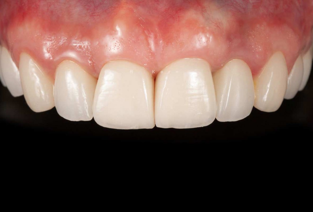 Immediate implant placement and periimplant bone augmentation using cerabone® - Dr. R. Kern 
