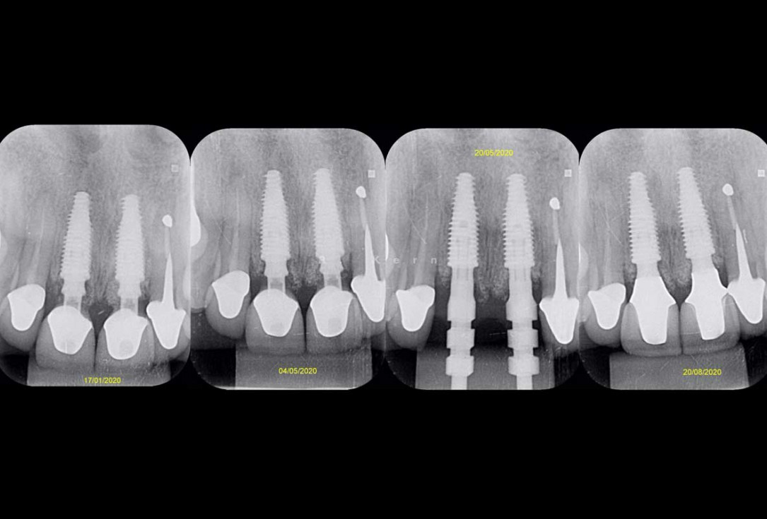 Immediate implant placement and periimplant bone augmentation using cerabone® - Dr. R. Kern 