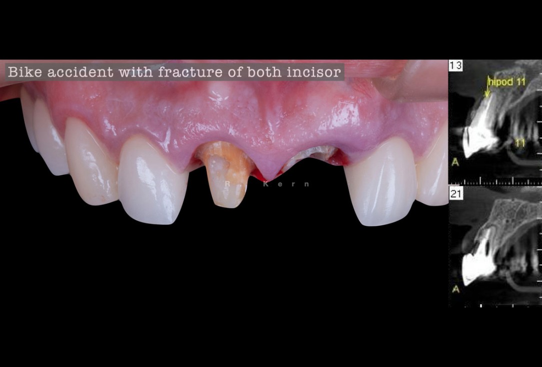 Immediate implant placement and periimplant bone augmentation using cerabone® - Dr. R. Kern 