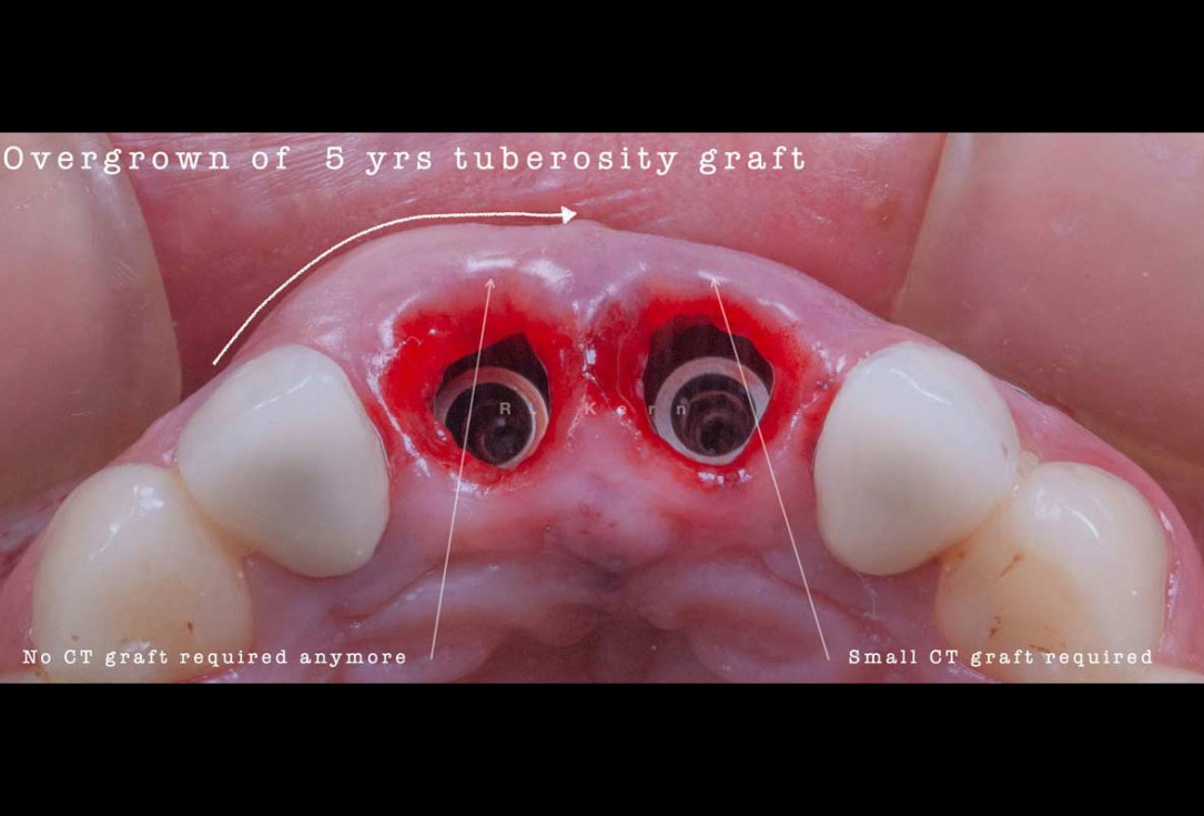 Immediate implant placement and periimplant bone augmentation using cerabone® - Dr. R. Kern 