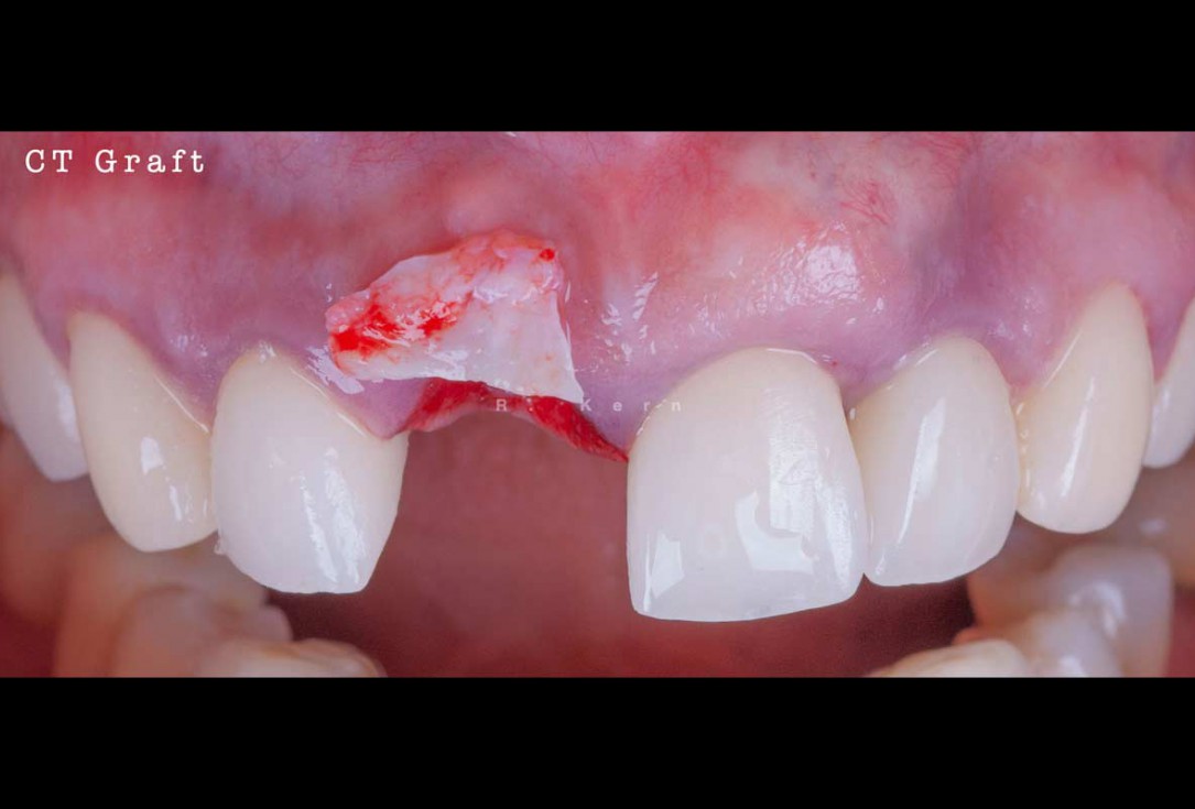 Immediate implant placement and periimplant bone augmentation using cerabone® - Dr. R. Kern 