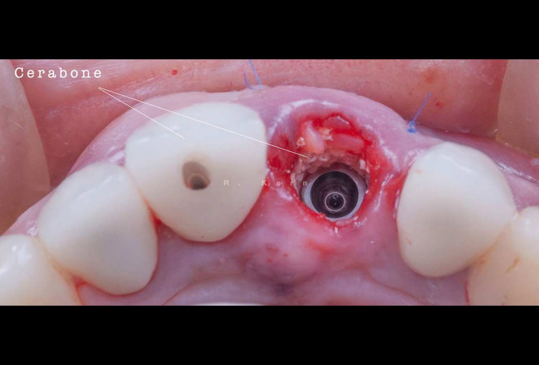 Immediate implant placement and periimplant bone augmentation using cerabone® - Dr. R. Kern 