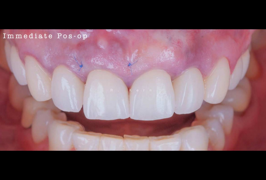Immediate implant placement and periimplant bone augmentation using cerabone® - Dr. R. Kern 