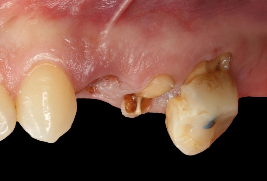 botiss cerabone® & collagen fleece for immediate implantation - Clinical case by Dr. D. Jelušić