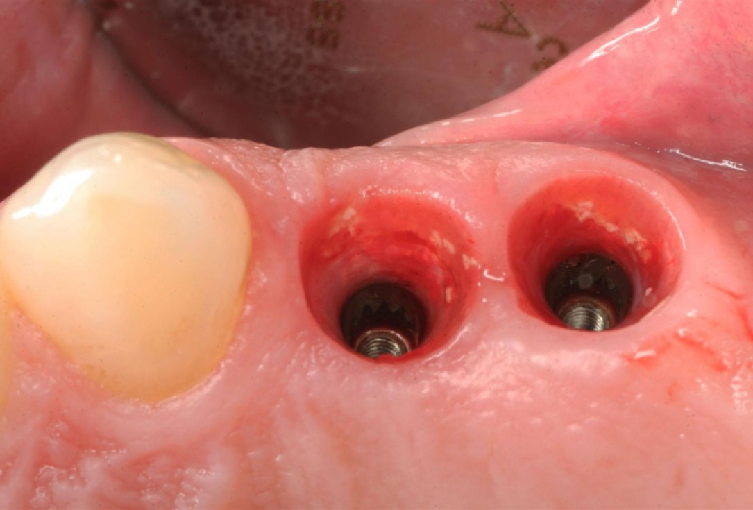 botiss cerabone® & collagen fleece for immediate implantation - Clinical case by Dr. D. Jelušić