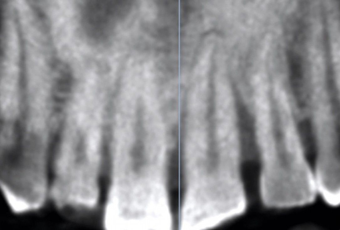Immediate implant placement using cerabone® and collagen fleece - Dr. D. Jelušić