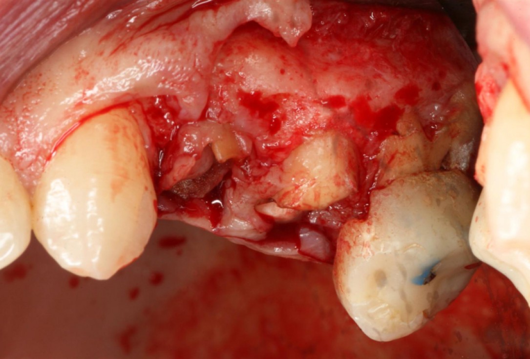 botiss cerabone® & collagen fleece for immediate implantation - Clinical case by Dr. D. Jelušić