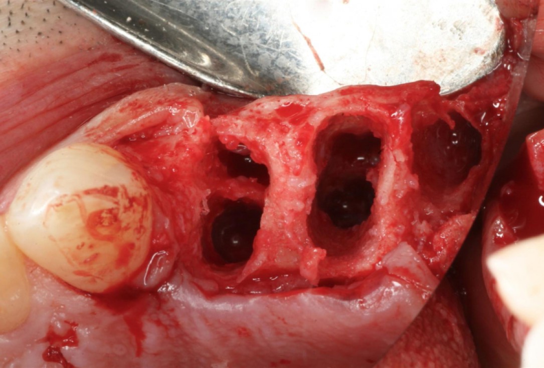 botiss cerabone® & collagen fleece for immediate implantation - Clinical case by Dr. D. Jelušić