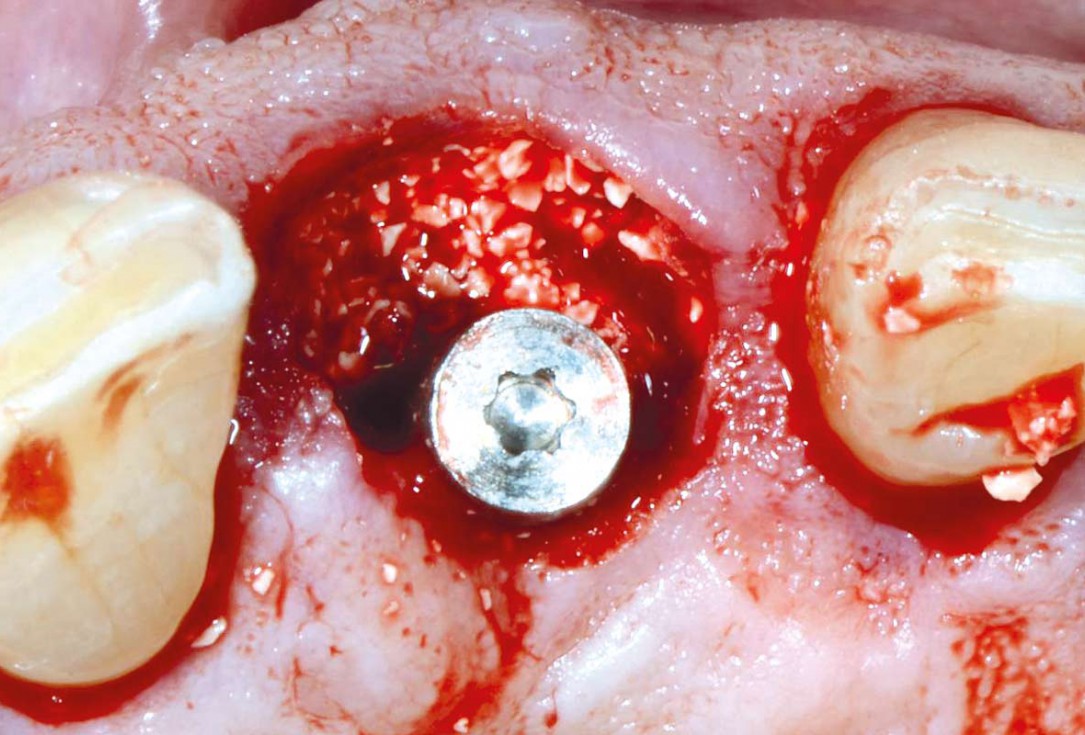 Immediate implant placement using cerabone® and collagen fleece - Dr. D. Jelušić