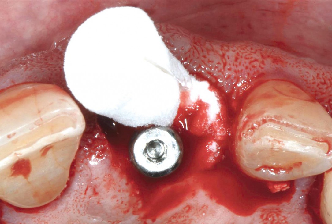 Immediate implant placement using cerabone® and collagen fleece - Dr. D. JelušićDr. D. Jelušić