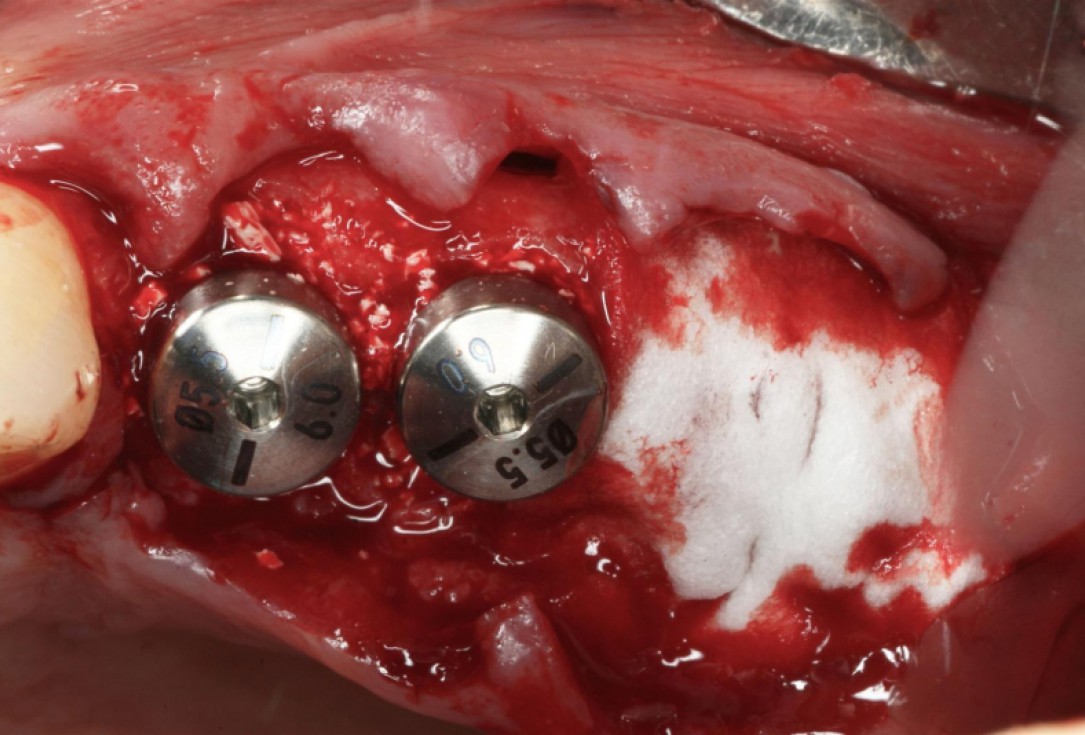 botiss cerabone® & collagen fleece for immediate implantation - Clinical case by Dr. D. Jelušić