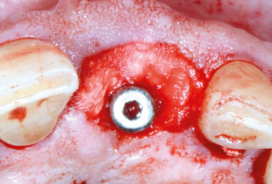 Immediate implant placement using cerabone® and collagen fleece - Dr. D. Jelušić