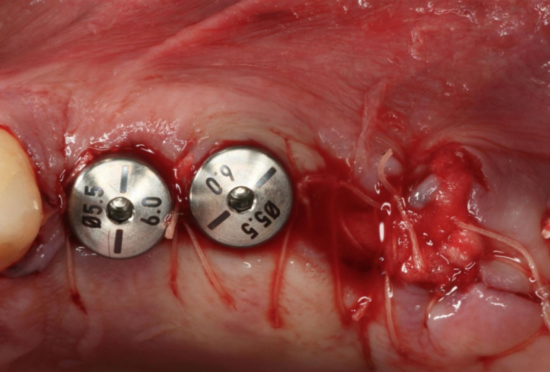 botiss cerabone® & collagen fleece for immediate implantation - Clinical case by Dr. D. Jelušić