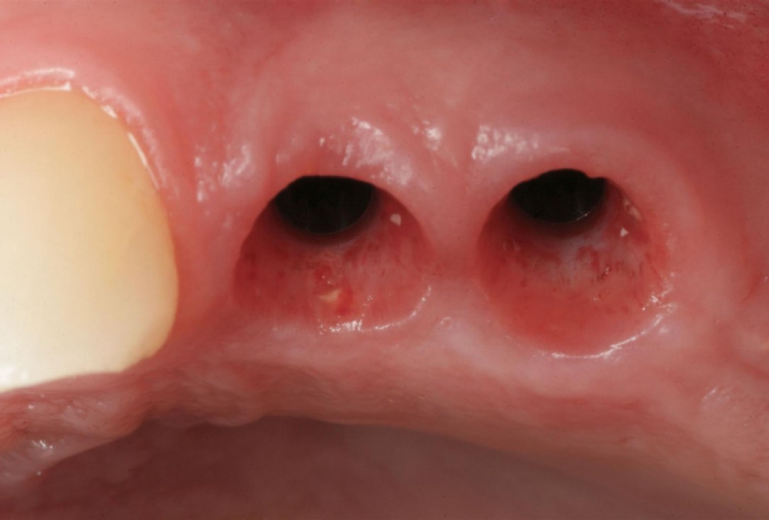botiss cerabone® & collagen fleece for immediate implantation - Clinical case by Dr. D. Jelušić