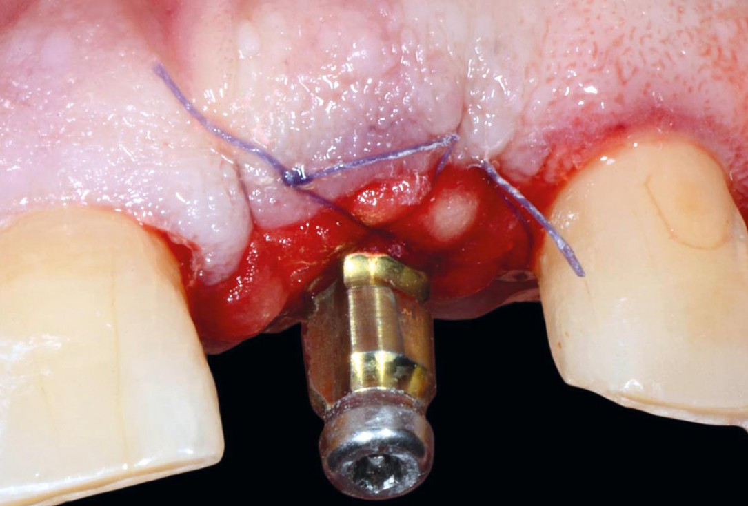 Immediate implant placement using cerabone® and collagen fleece - Dr. D. Jelušić