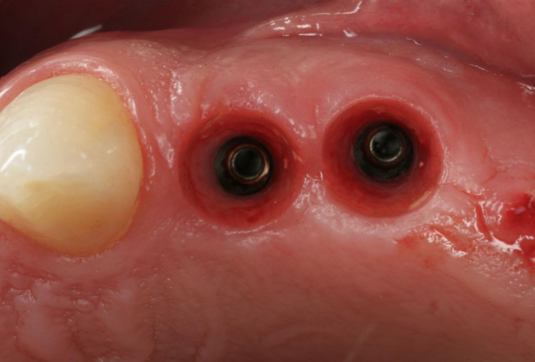 botiss cerabone® & collagen fleece for immediate implantation - Clinical case by Dr. D. Jelušić