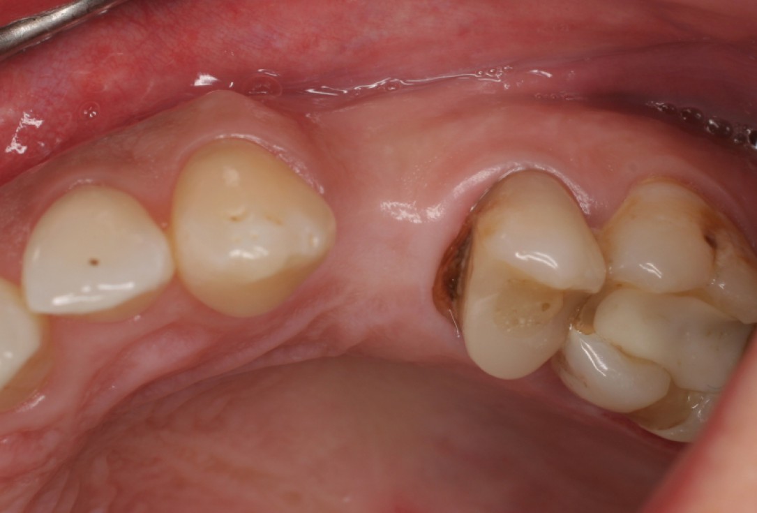 botiss cerabone® & Jason® membrane for horizontal augmentation - clinical case by Prof. Dr. Dr. D. Rothamel